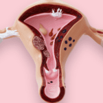 Sindrome ovario poliquistico